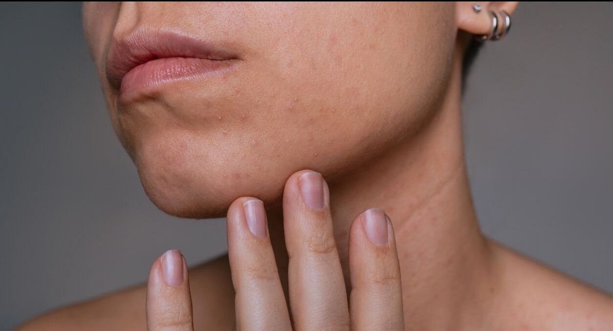 woman with uneven skin texture.jpg