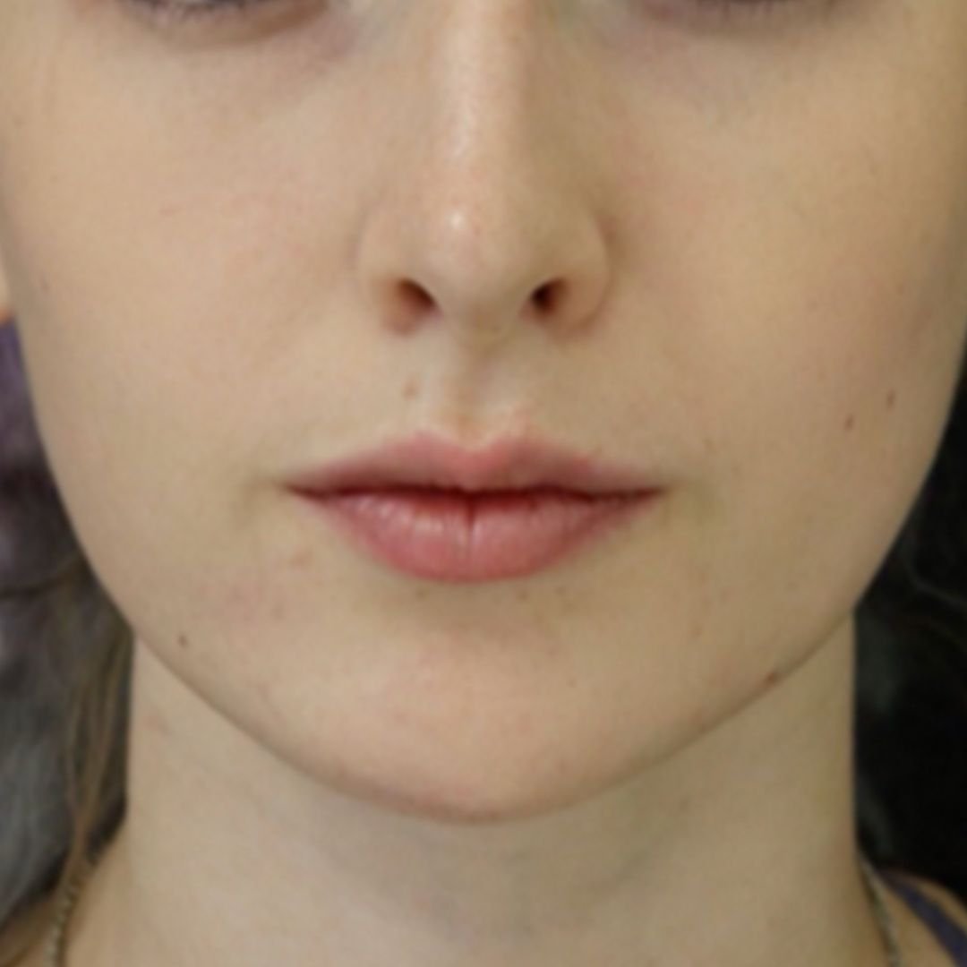 Botox Before & After Photos | PHI Clinic London